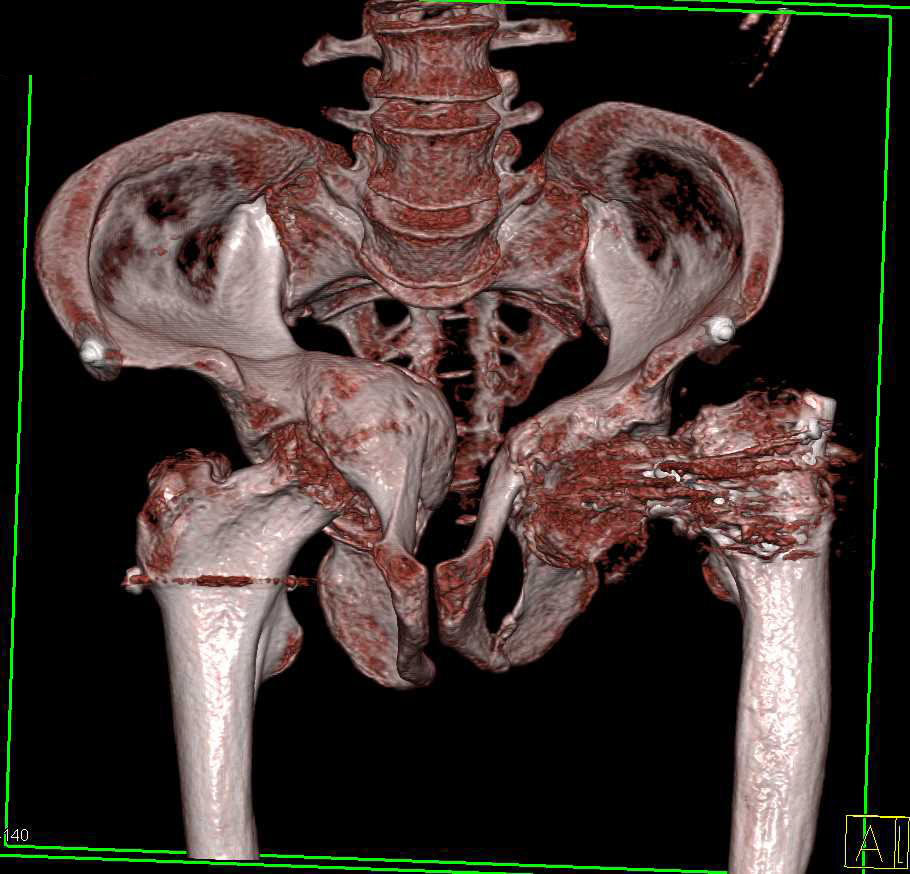 Osteogenesis Imperfecta with Left Femur Fracture - CTisus CT Scan