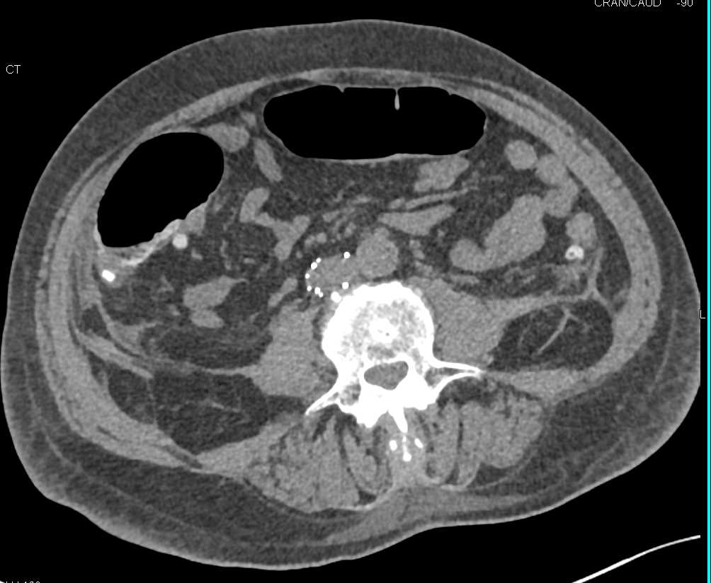 Right Acetabular Fracture with Pelvic Hematoma - CTisus CT Scan