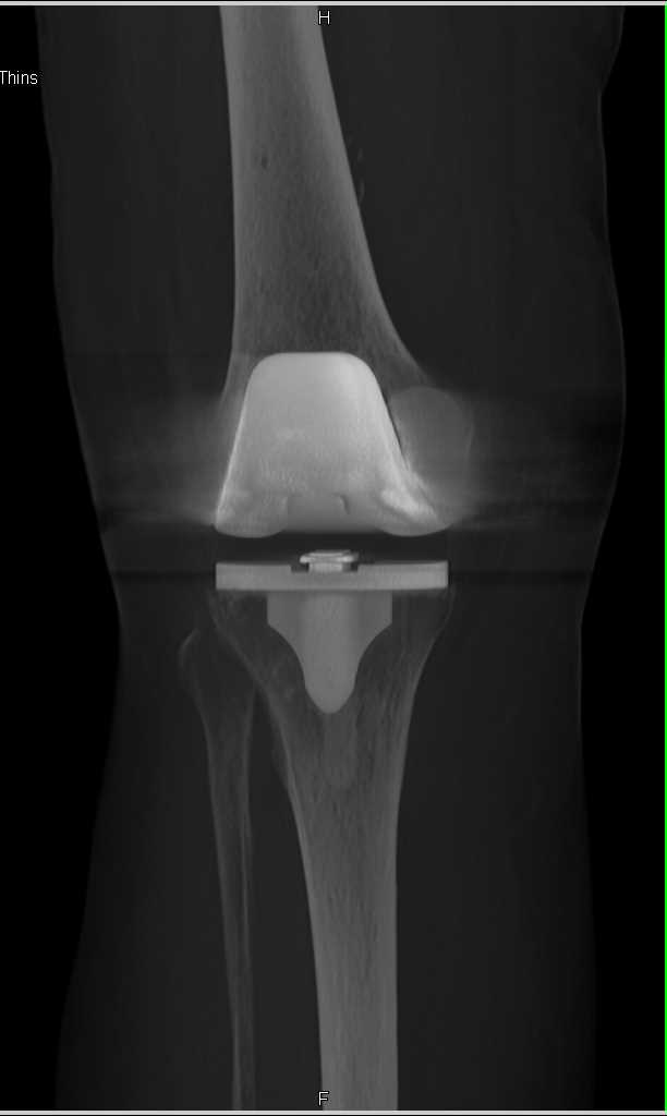 Total Knee Replacement in 3D - CTisus CT Scan