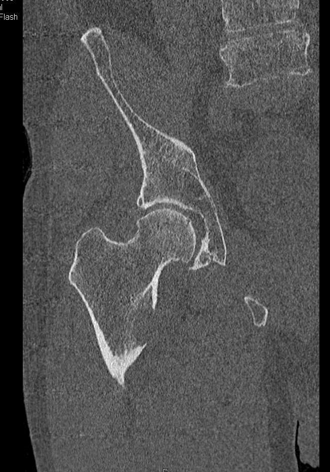 Multiple Myeloma - CTisus CT Scan