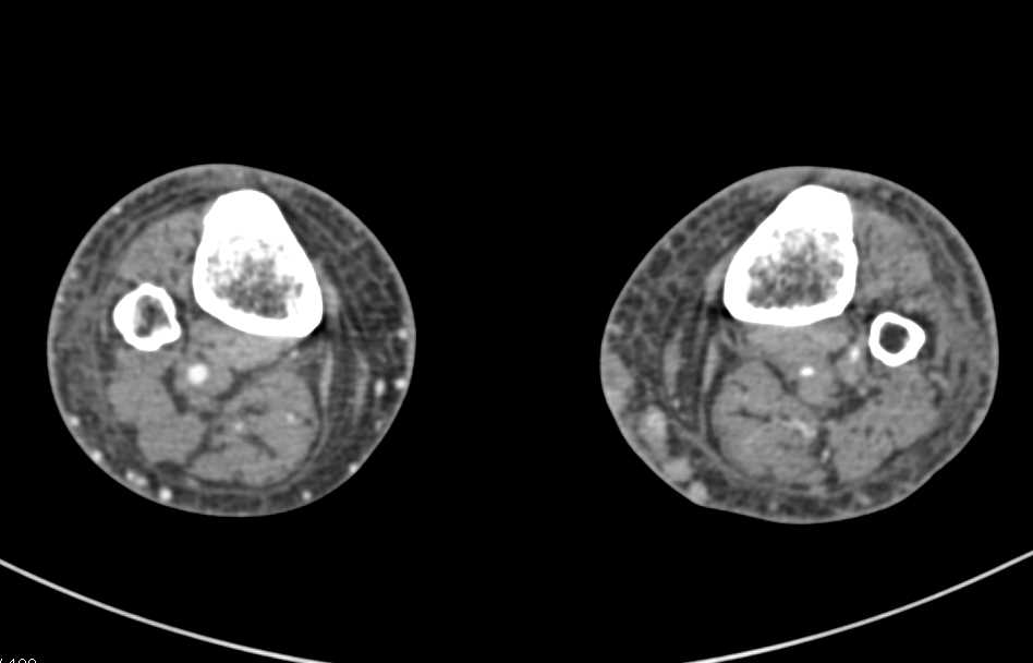 Venous Stasis in a Patient with Hepatocellular Carcinoma (Hepatoma) and Ascites - CTisus CT Scan