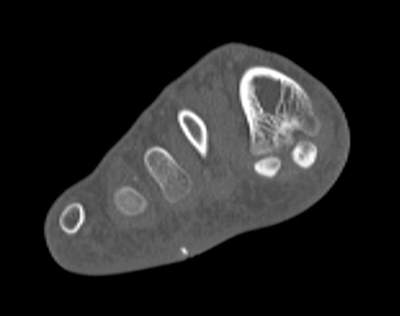 Foreign Body (Pin) in Soft Tissues Plantar Surface Foot - CTisus CT Scan