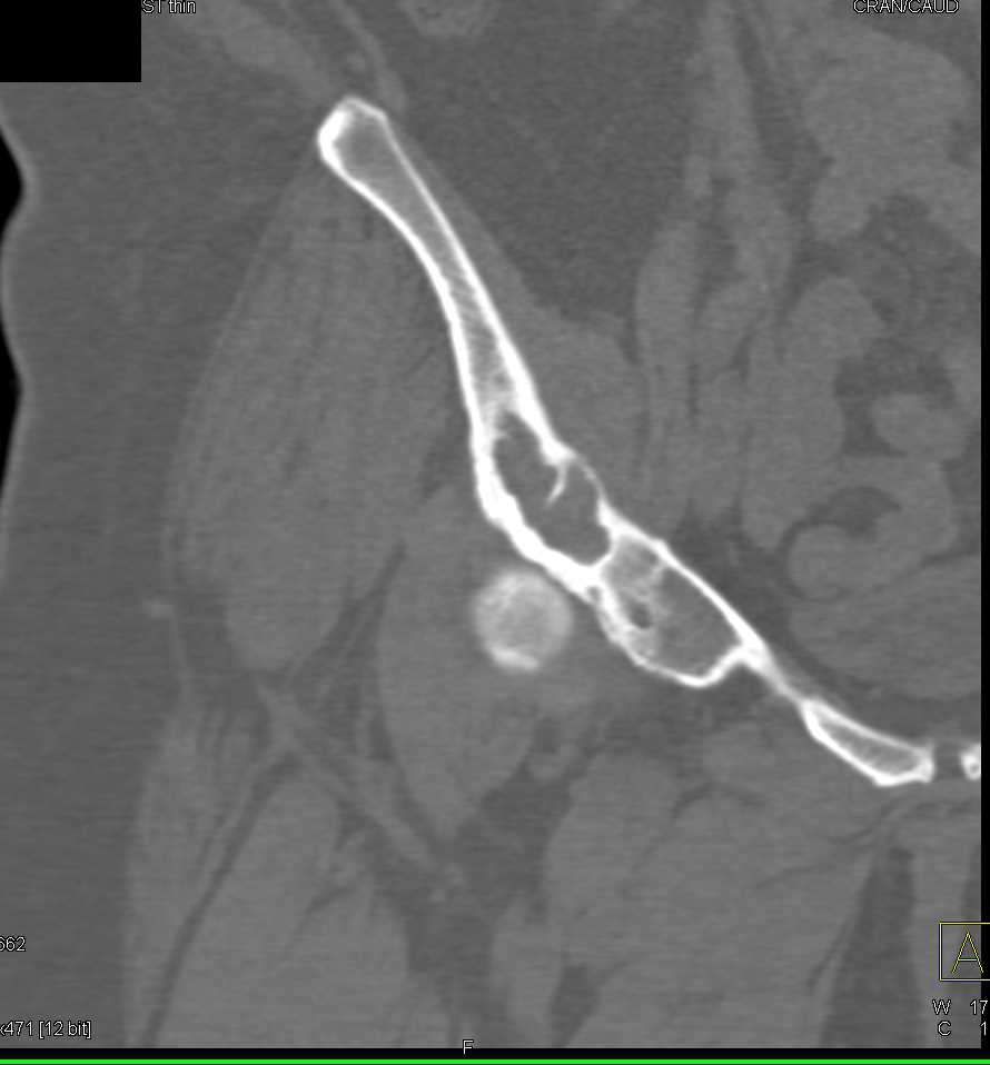 Degenerative Joint Disease (DJD) with Cystic Changes Acetabulum - CTisus CT Scan