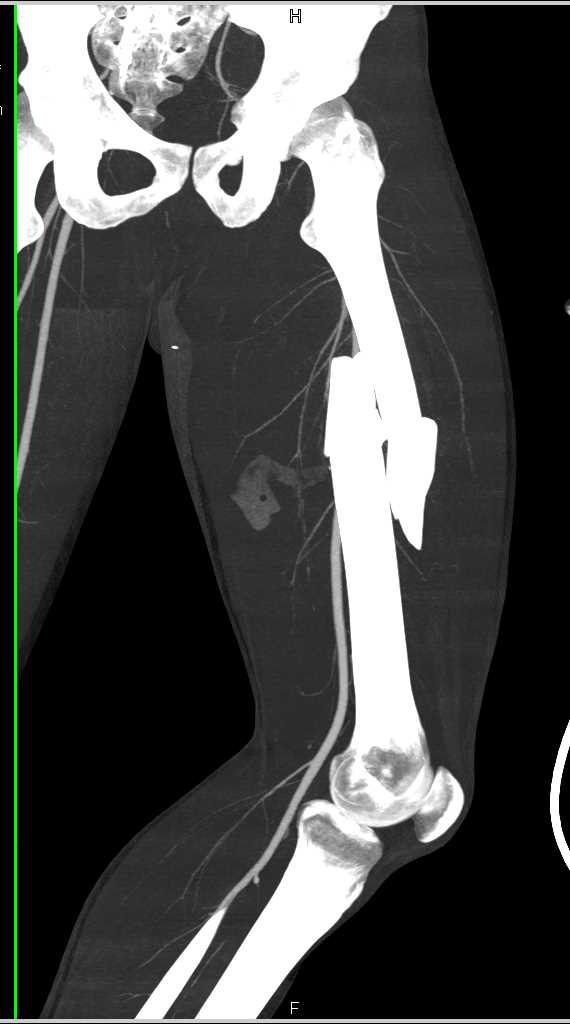 Spiral Femur Fracture Without Vascular Injury - CTisus CT Scan