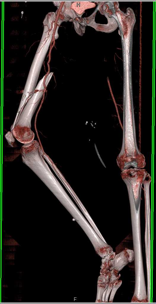 Gunshot to Thigh With Femur Fracture but Intact Vasculature - CTisus CT Scan