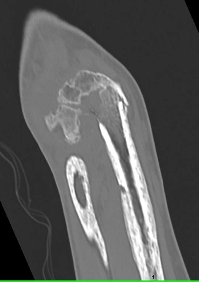 Chronic Osteomyelitis - CTisus CT Scan