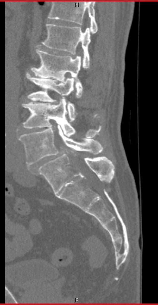 Degenerative Joint Disease (DJD) of Lumbar Spine - CTisus CT Scan