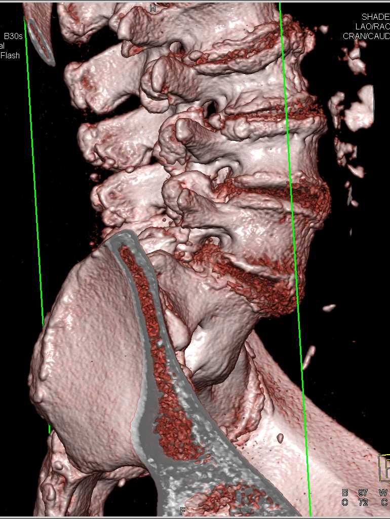 degenerative-joint-disease-djd-of-lumbar-spine-musculoskeletal-case