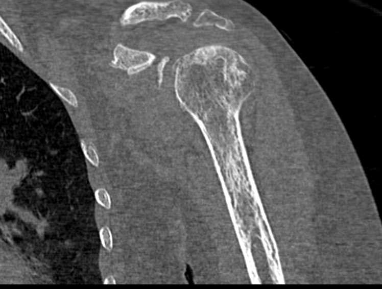 Diffuse Osteoprosis of the Left Shoulder - CTisus CT Scan
