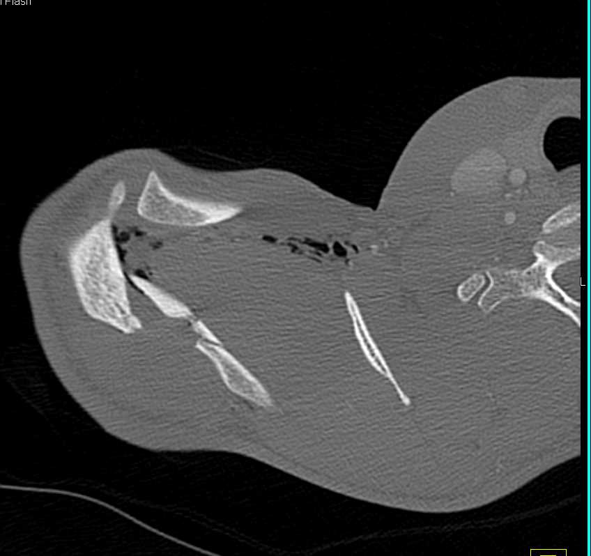 Scapular Fracture due to GSW - CTisus CT Scan