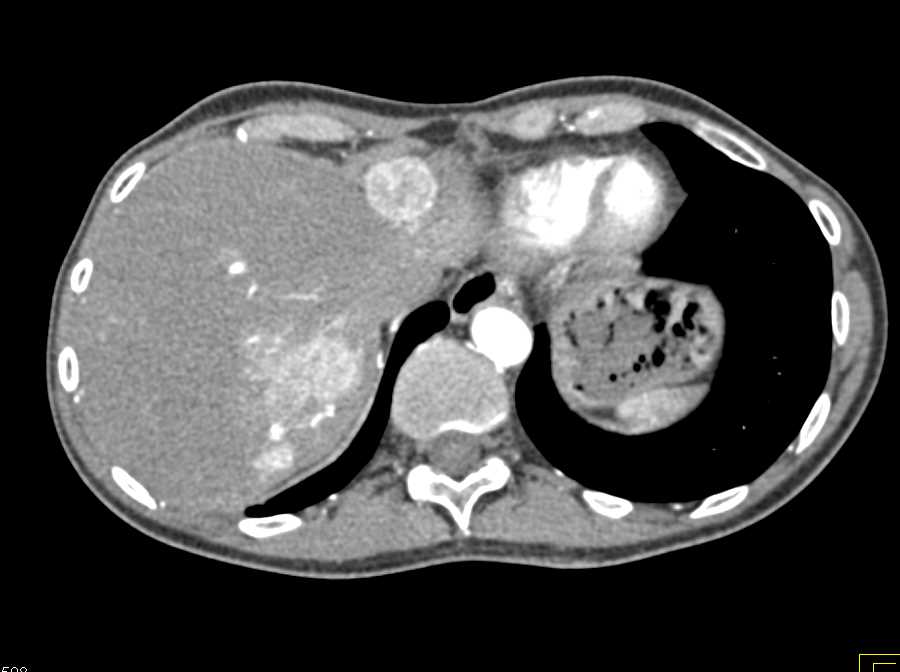 Neuroendocrine Tumor with Vascular Liver and Bone Metastases - CTisus CT Scan