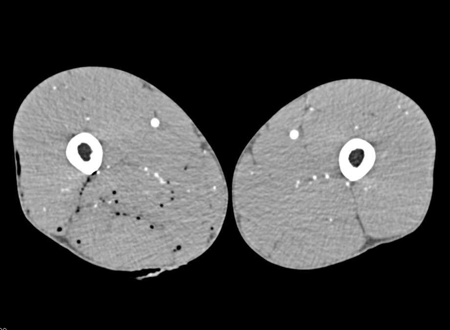 GSW Thigh with No Evidence of Vascular Injury - CTisus CT Scan