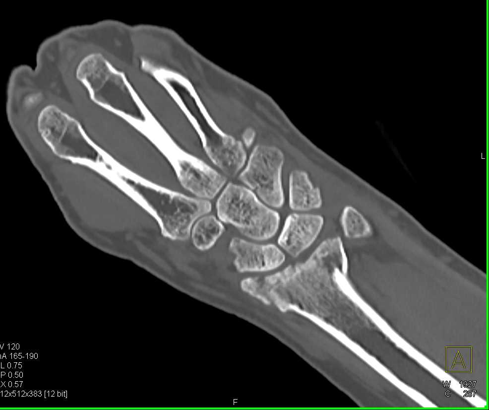 Fracture of the Distal Radius - CTisus CT Scan