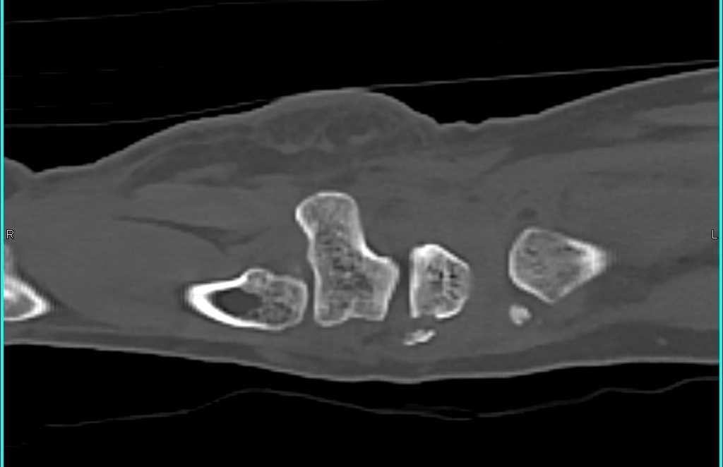 Fracture Involves Distal Radius and Navicular - CTisus CT Scan