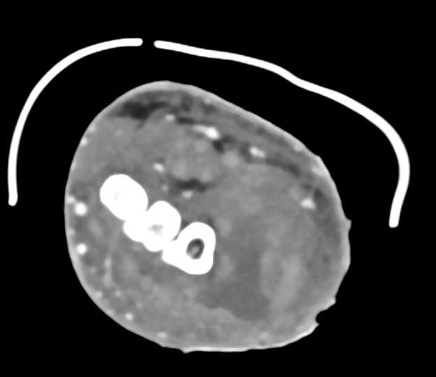 Deep Abscess in the Wrist - CTisus CT Scan