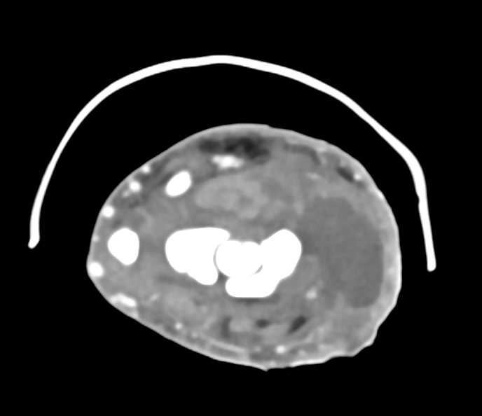 Complex Abscess Involving the Hand and Wrist - CTisus CT Scan