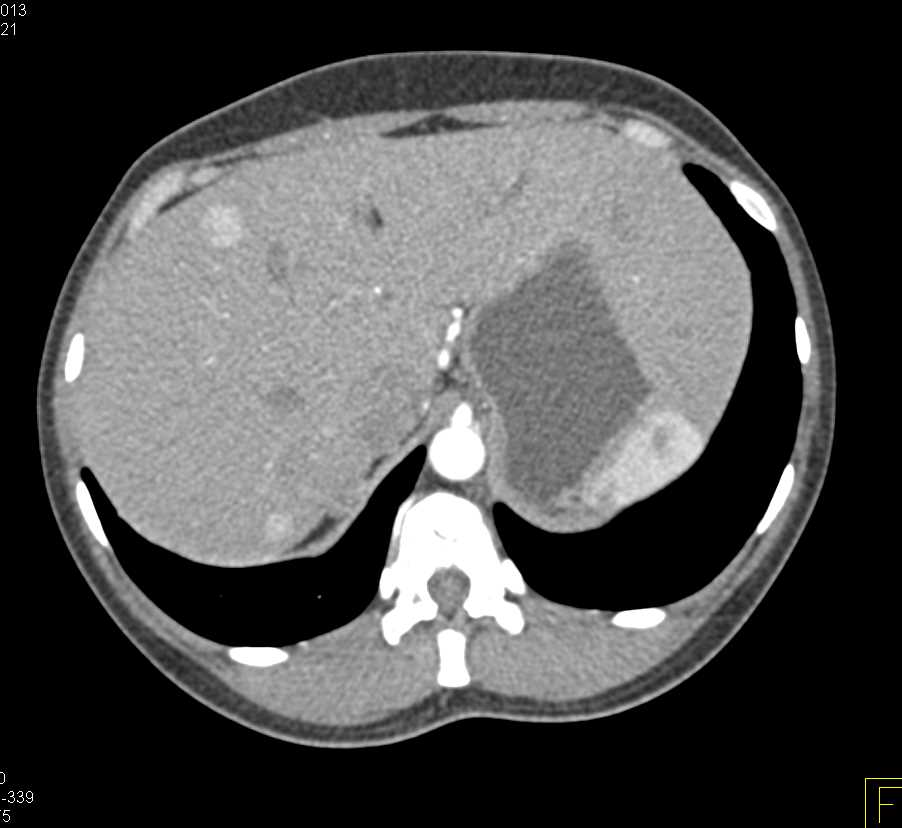 Metastatic Neuroendocrine Tumor to the Liver and Spine - CTisus CT Scan