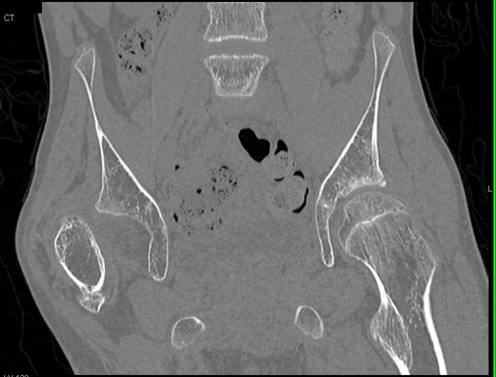 Congenital Left Hip Dislocation with Remolded Acetabulum - CTisus CT Scan