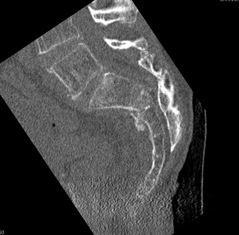 Sacral Insufficiency Fractures Through Osteopenic Bone - CTisus CT Scan