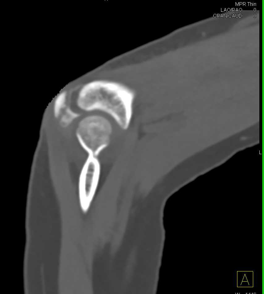 Olecranon Fracture with Soft Tissue injury - CTisus CT Scan