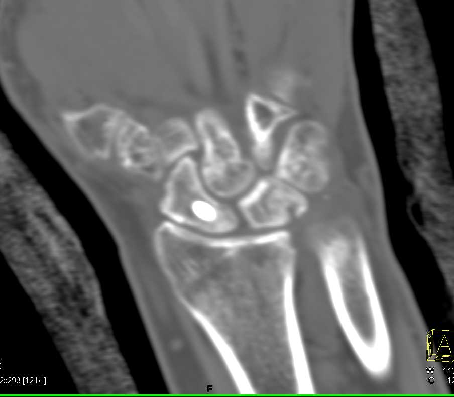 Pinning of Scaphoid Fracture - Musculoskeletal Case Studies - CTisus CT ...