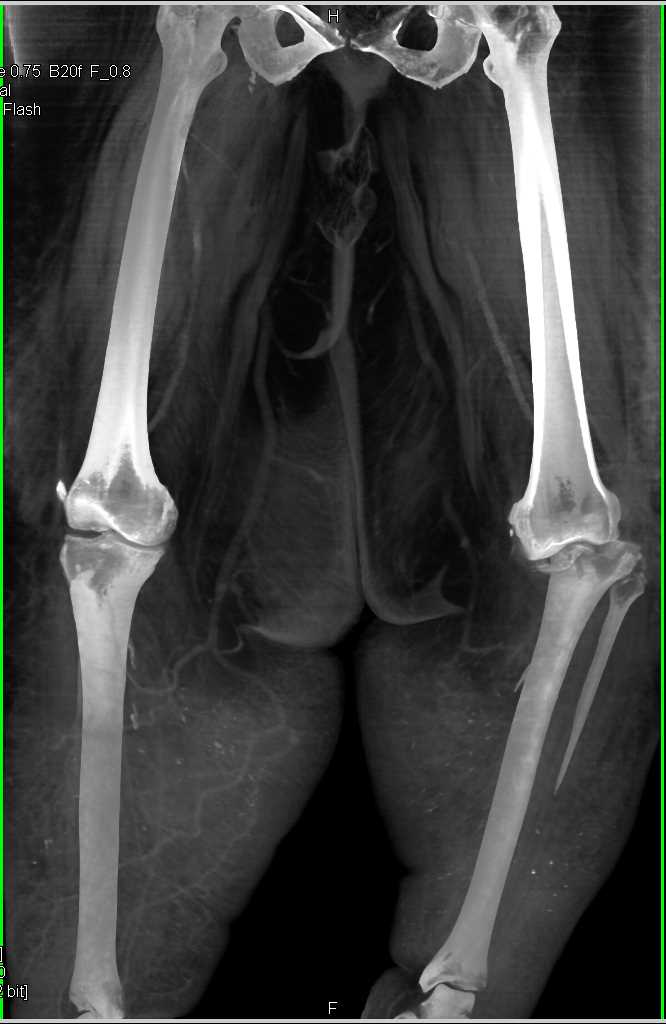 CTA of Lower Extremities in Patient With Cellulitis - CTisus CT Scan