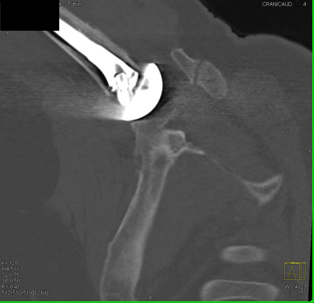 Right Shoulder Prosthesis - CTisus CT Scan