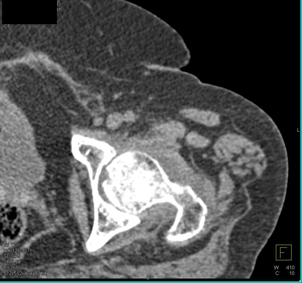 Osteoporosis Left Femoral Head and Joint Effusion - CTisus CT Scan