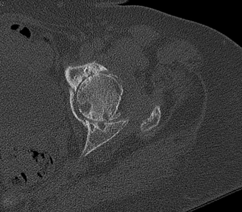 Severe Osteoarthritis Hip - CTisus CT Scan