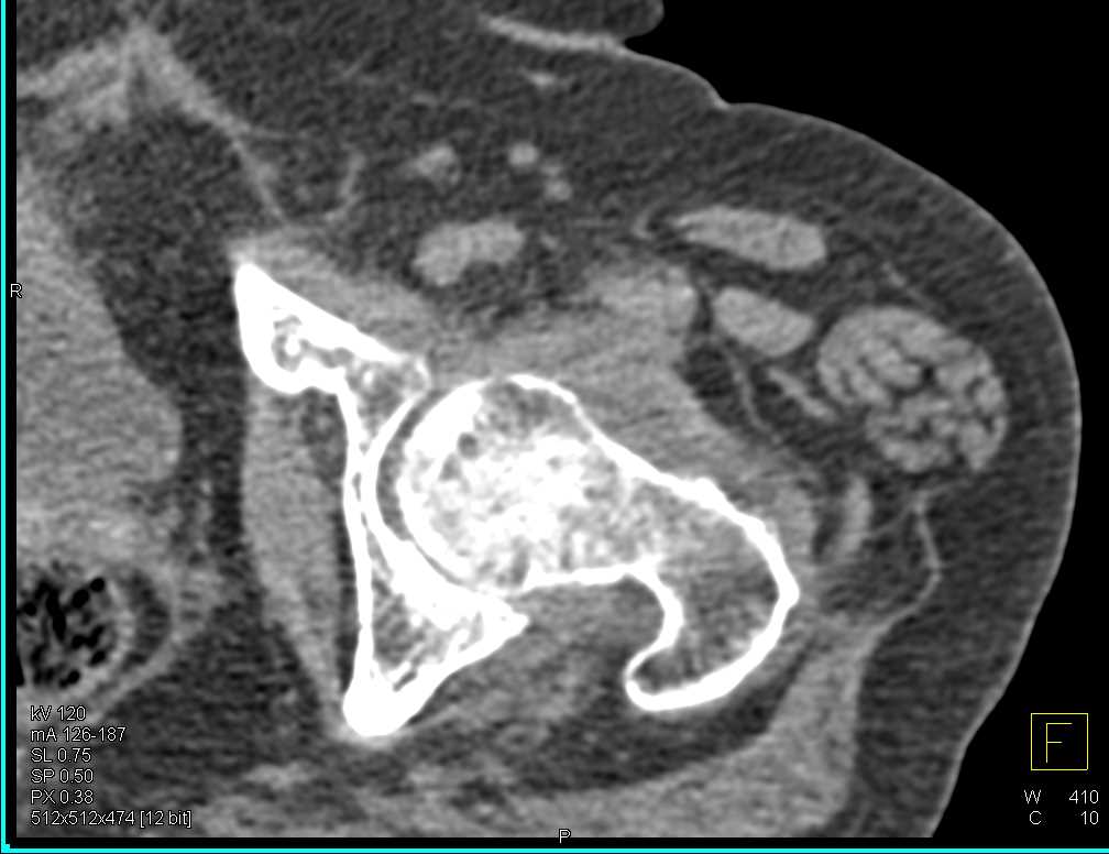 Subtle Femur Fracture with Joint Effusion - CTisus CT Scan