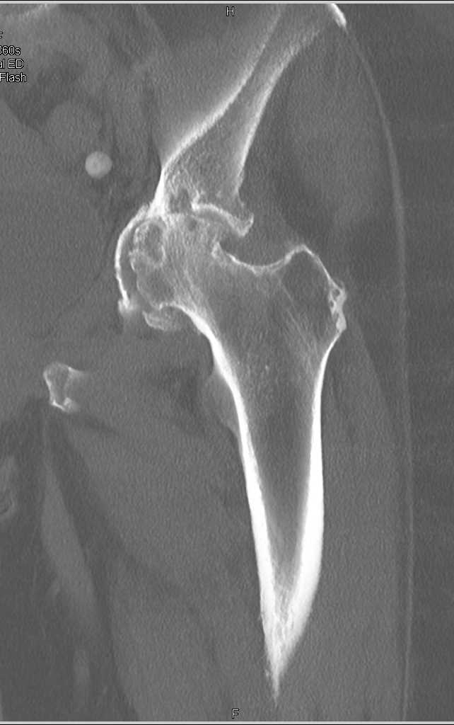 Degenerative Osteoarthritis Left Hip Joint - CTisus CT Scan