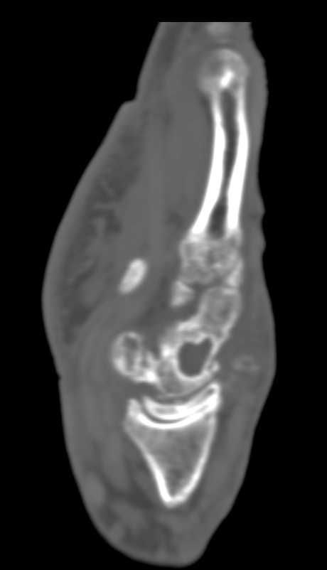Repetitive Trauma to the Carpal Bones - CTisus CT Scan