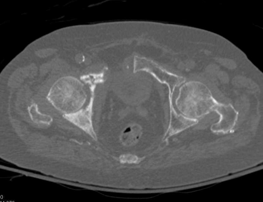 Blastic Metastases to the Right Hemipelvis with Fracture - CTisus CT Scan