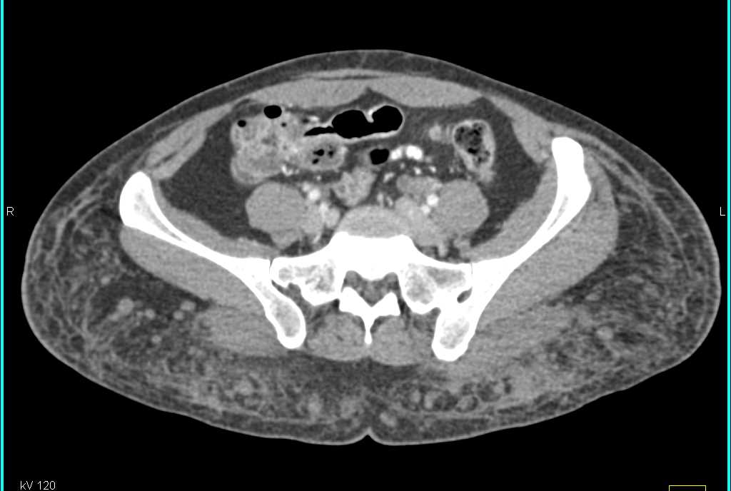 Multiple Neurofibromas in the Soft Tissues of the Buttocks - CTisus CT Scan