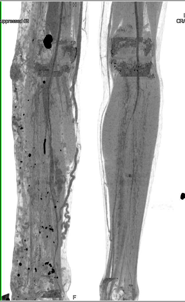 Diffuse Muscle Atrophy Right Lower Extremity with Lymphatic Engorgement - CTisus CT Scan