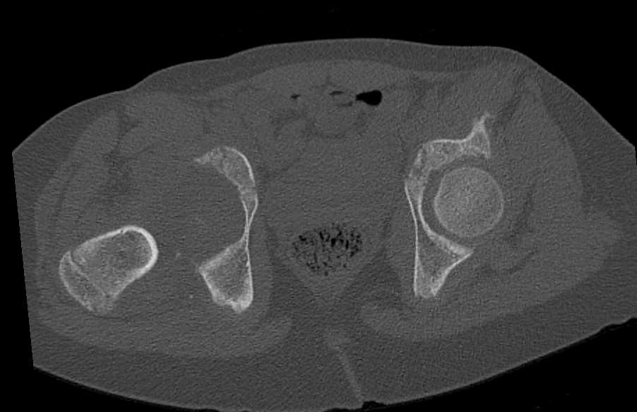 Right Hip Dislocation in 3D - CTisus CT Scan