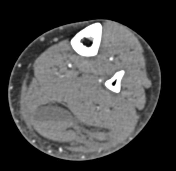 Hematoma Calf with Bleed and Fluid Level - CTisus CT Scan