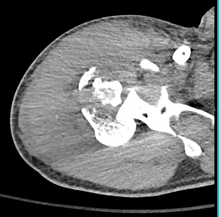 Comminuted Humerus Fracture - CTisus CT Scan