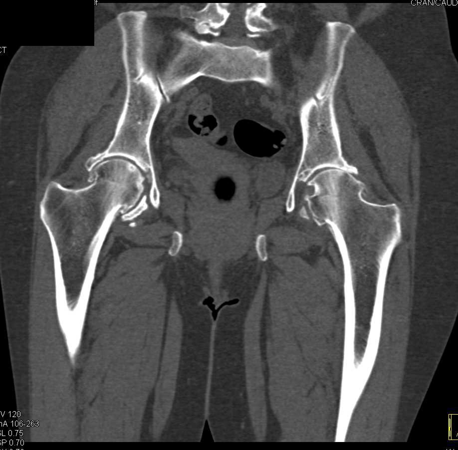 Avascular Necrosis (AVN) Right Hip - CTisus CT Scan