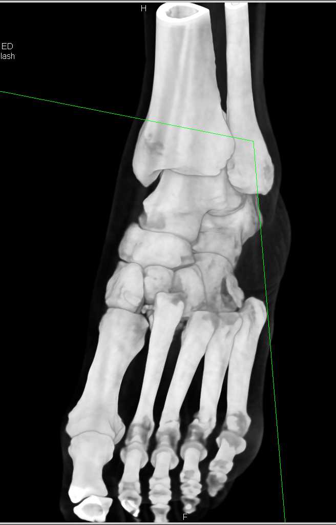 Multiple Fractures with Midfoot Dislocation or Lisfranc Fracture/Dislocation Injury - CTisus CT Scan