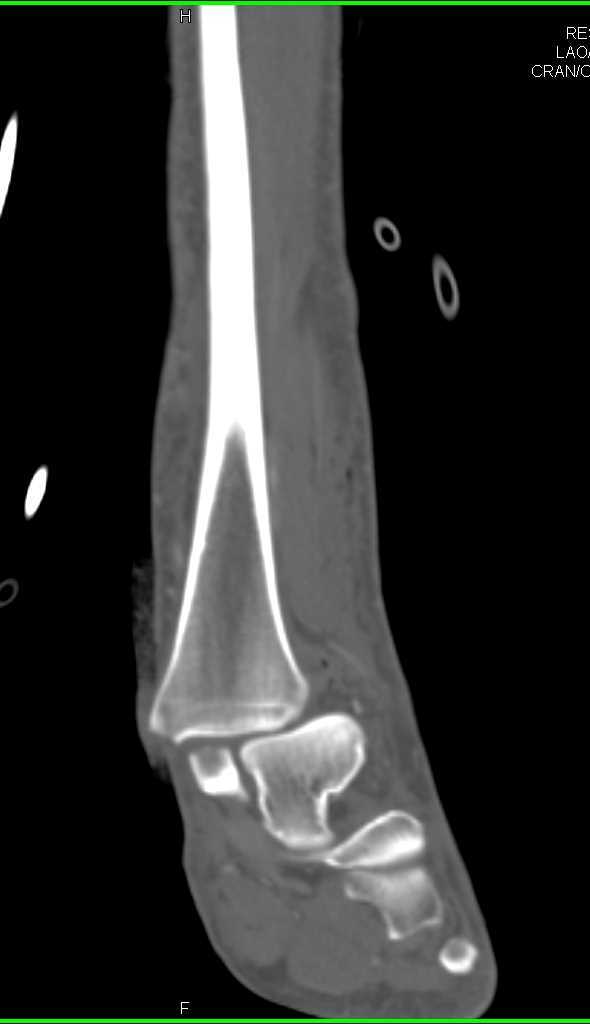 Fracture Dislocation of the Ankle Joint - CTisus CT Scan