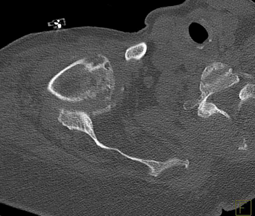 Fracture Dislocation of the Shoulder With Evidence of Repeated Dislocations - CTisus CT Scan