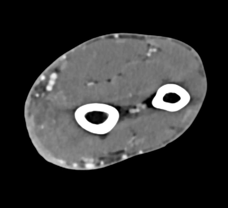 Abscess with Cellulitis in the Forearm - CTisus CT Scan