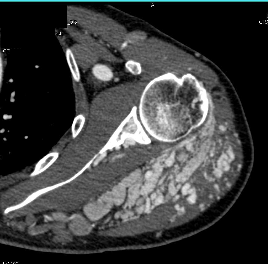 Heterotopic Ossification in a Renal Dialysis Patient - CTisus CT Scan