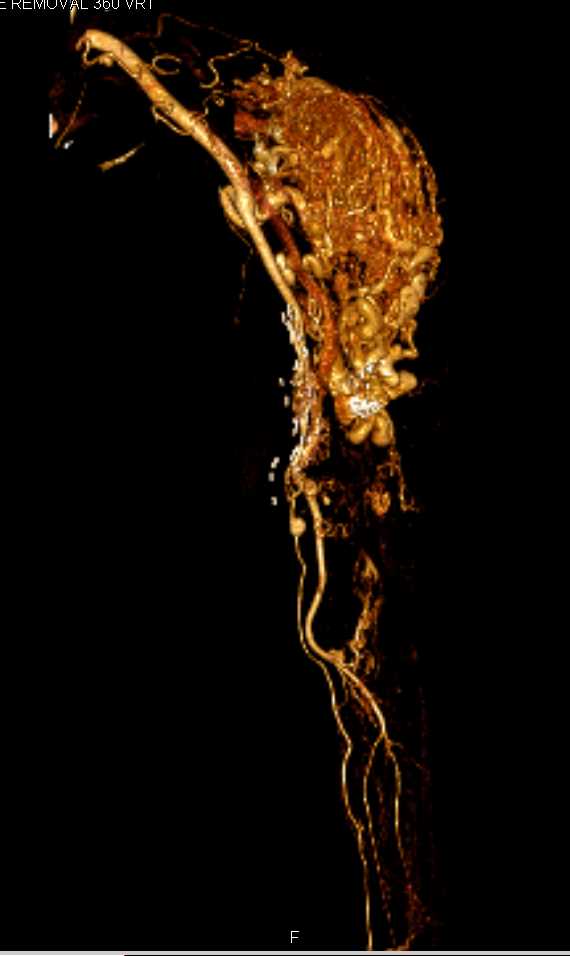 Heterotopic Ossification in a Renal Dialysis Patient - CTisus CT Scan