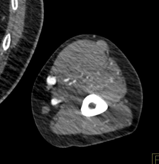 Heterotopic Ossification in a Renal Dialysis Patient - CTisus CT Scan