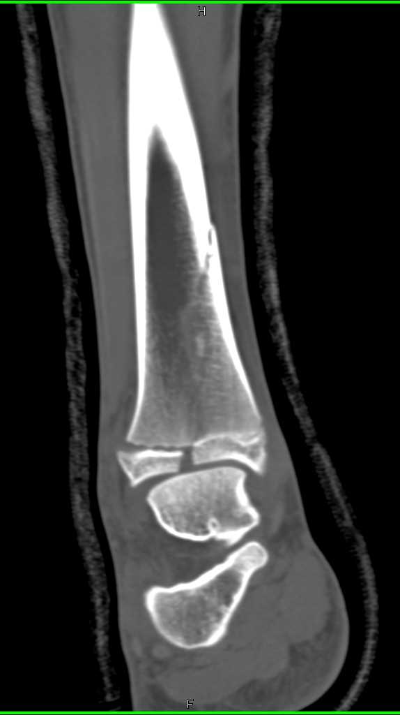 Tibial Fracture Extends through Epiphyseal Plate and to Articular Surface - CTisus CT Scan