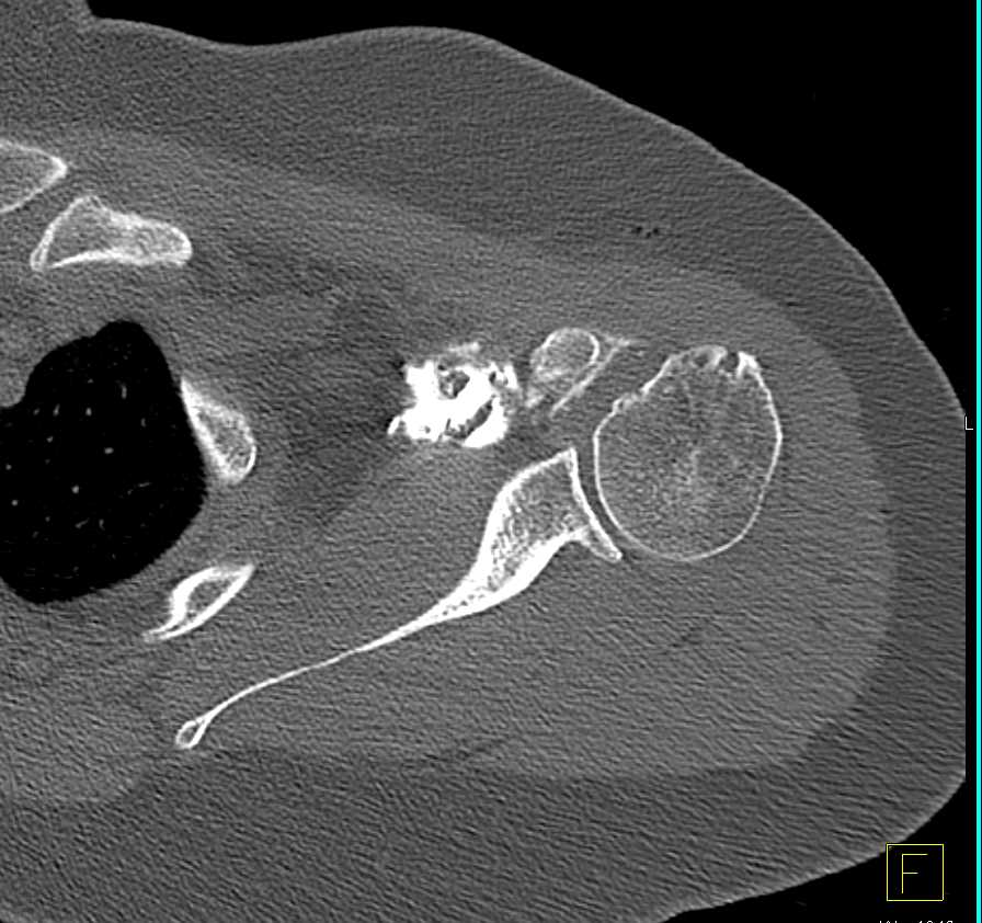 CT Arthrogram with Failed Injection - CTisus CT Scan