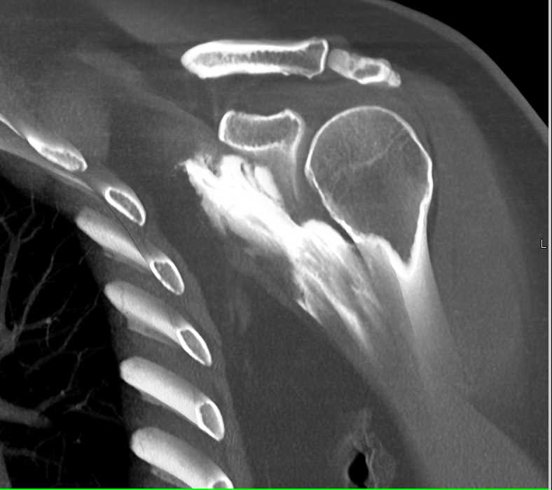 CT Arthrogram with Failed Injection - CTisus CT Scan