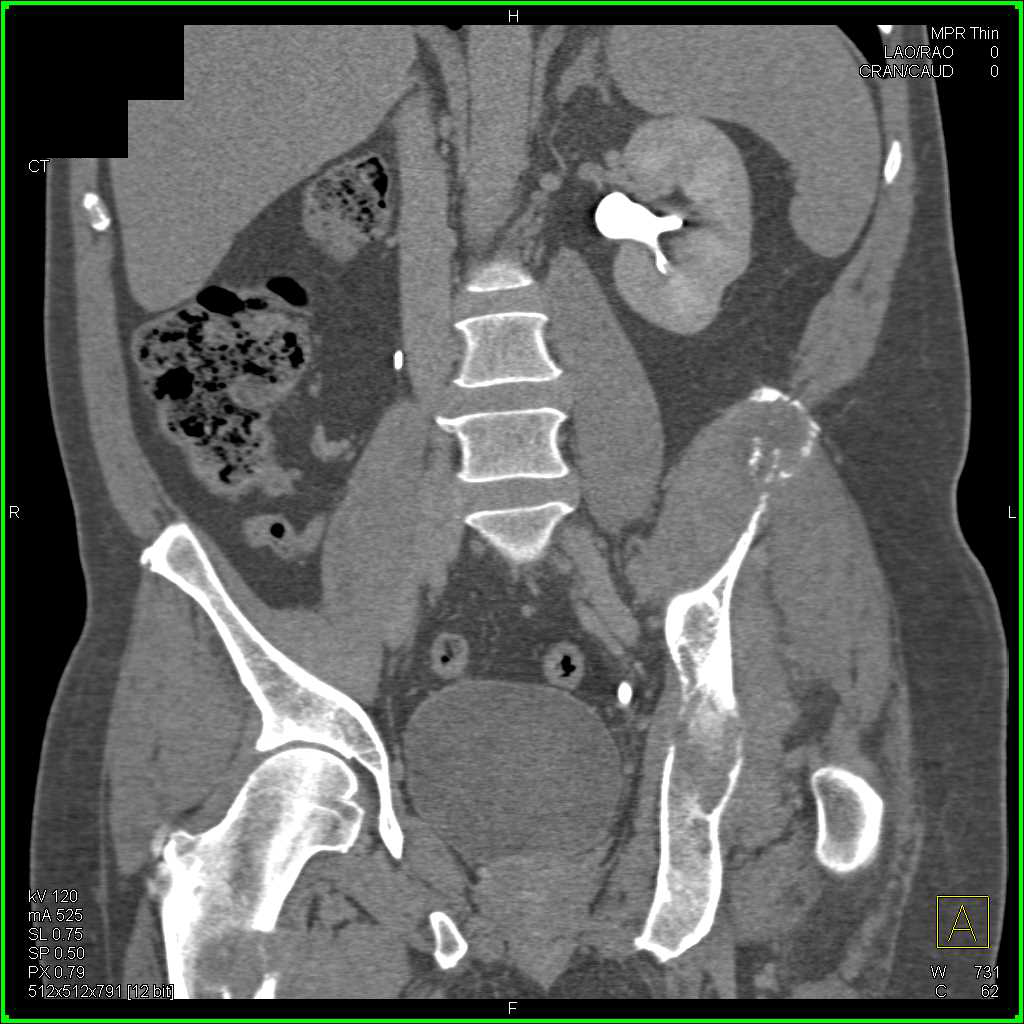 Metastatic Renal Cell Carcinoma to Bone Especially in Left Pelvis - CTisus CT Scan